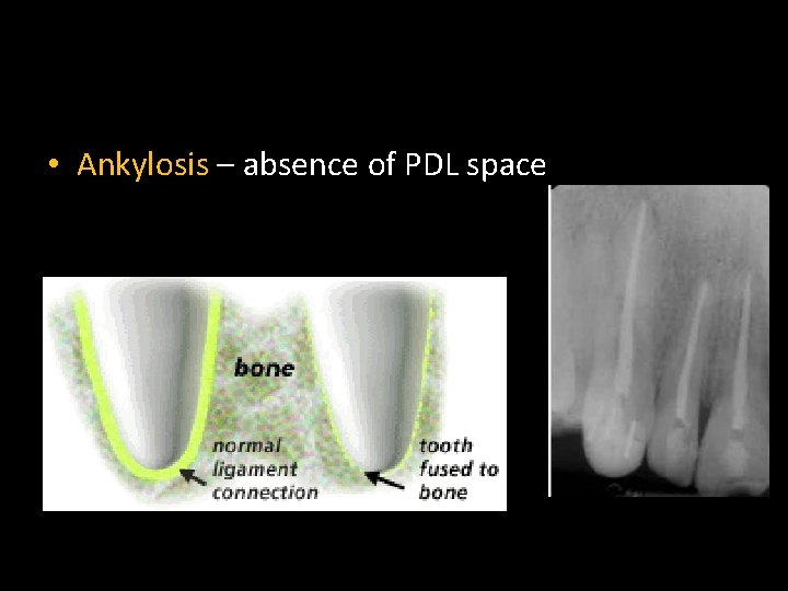  • Ankylosis – absence of PDL space 