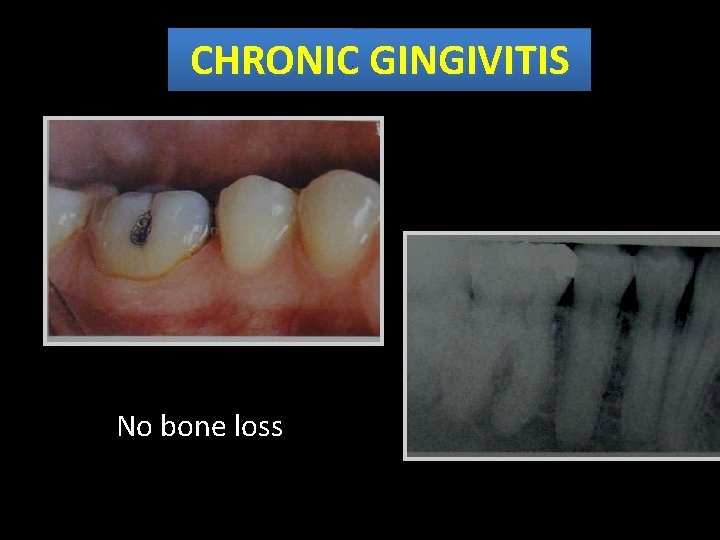 CHRONIC GINGIVITIS • No No bone loss 