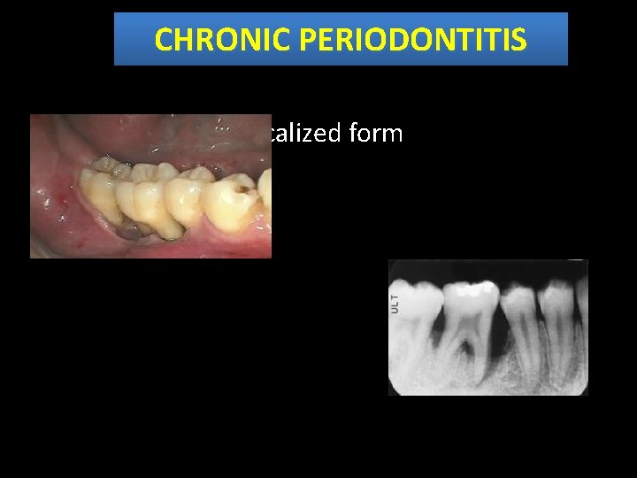 CHRONIC PERIODONTITIS Localized form 