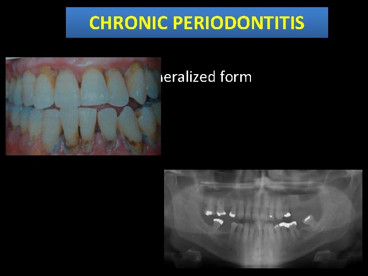 CHRONIC PERIODONTITIS Generalized form 