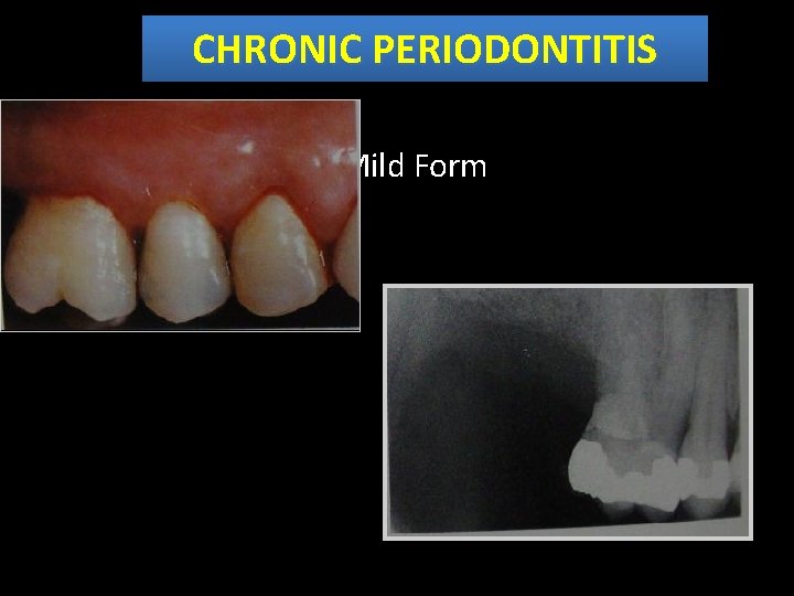 CHRONIC PERIODONTITIS • Mild Form 