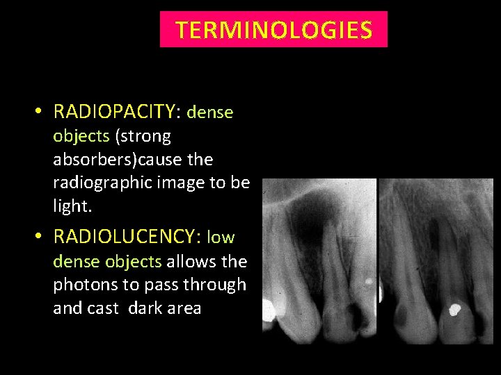 TERMINOLOGIES • RADIOPACITY: dense objects (strong absorbers)cause the radiographic image to be light. •