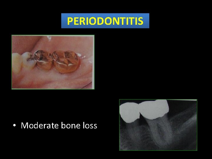 PERIODONTITIS • Moderate bone loss 