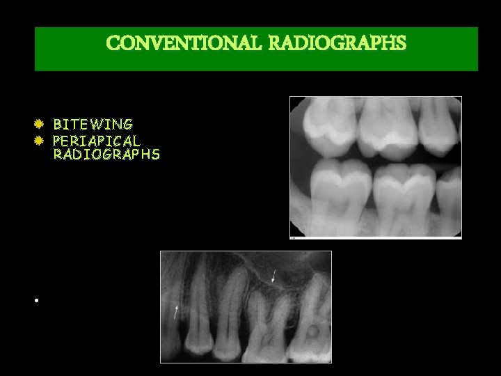 CONVENTIONAL RADIOGRAPHS BITEWING PERIAPICAL RADIOGRAPHS • 