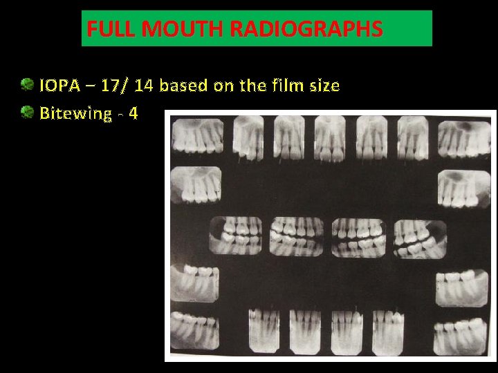 FULL MOUTH RADIOGRAPHS IOPA – 17/ 14 based on the film size Bitewing -