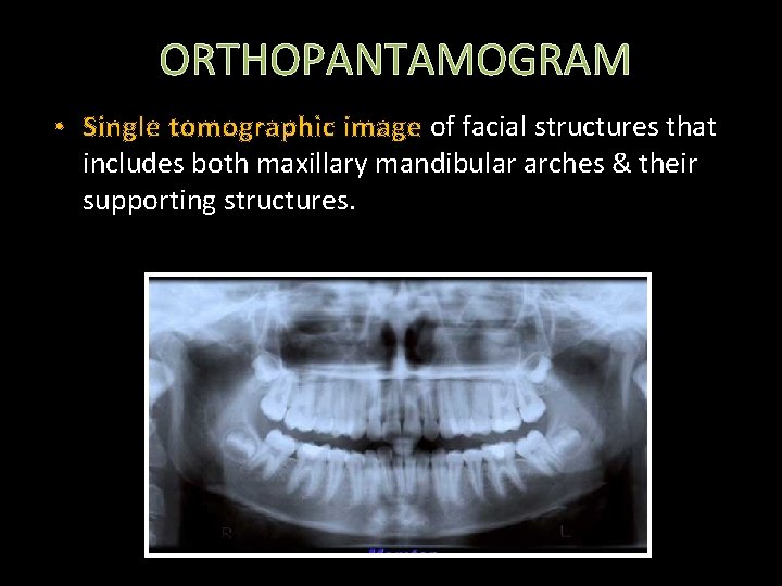 ORTHOPANTAMOGRAM • Single tomographic image of facial structures that includes both maxillary mandibular arches