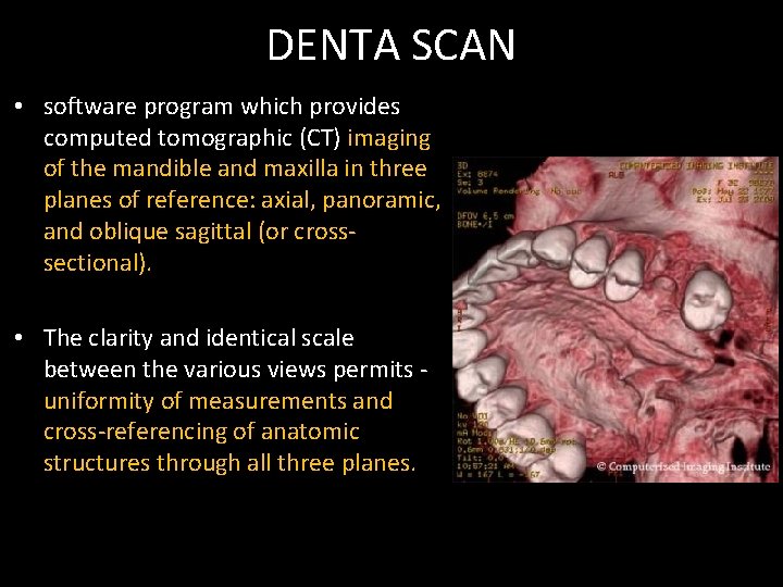 DENTA SCAN • software program which provides computed tomographic (CT) imaging of the mandible