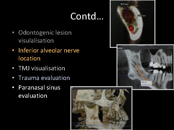 Contd… • Odontogenic lesion visulalisation • Inferior alveolar nerve location • TMJ visualisation •