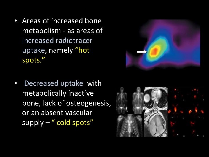  • Areas of increased bone metabolism - as areas of increased radiotracer uptake,