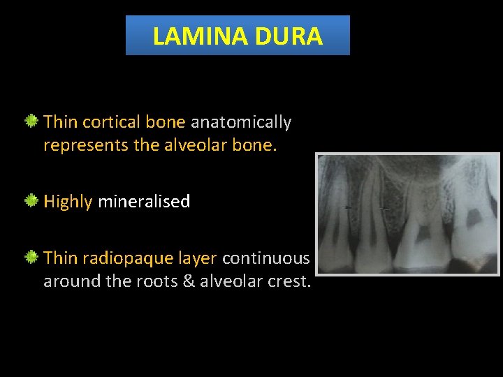 LAMINA DURA Thin cortical bone anatomically represents the alveolar bone. Highly mineralised Thin radiopaque