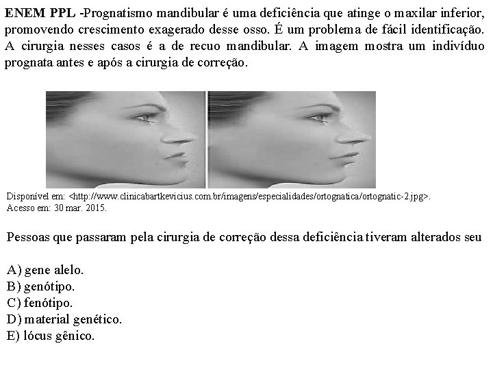 ENEM PPL -Prognatismo mandibular é uma deficiência que atinge o maxilar inferior, promovendo crescimento