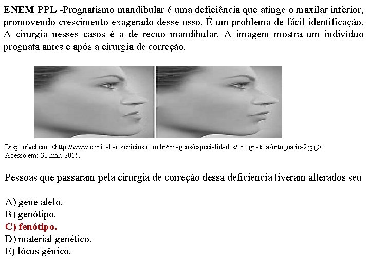 ENEM PPL -Prognatismo mandibular é uma deficiência que atinge o maxilar inferior, promovendo crescimento