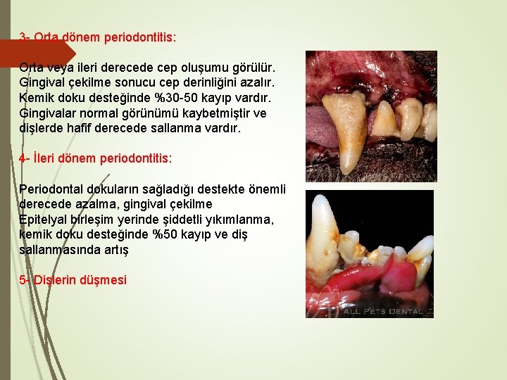 3 - Orta dönem periodontitis: Orta veya ileri derecede cep oluşumu görülür. Gingival çekilme 3 - Orta dönem periodontitis: Orta veya ileri derecede cep oluşumu görülür. Gingival çekilme