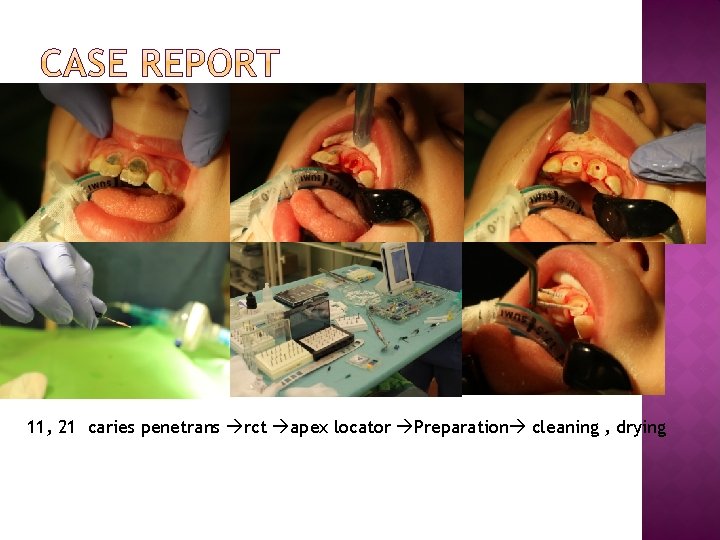 11, 21 caries penetrans rct apex locator Preparation cleaning , drying 