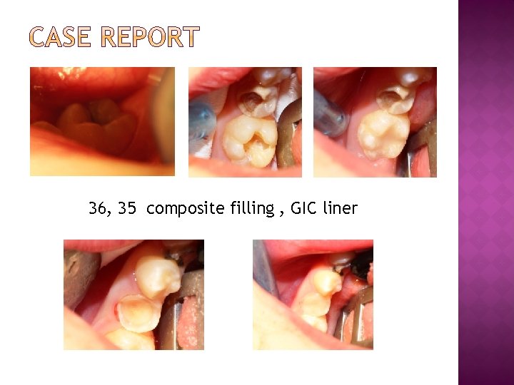 36, 35 composite filling , GIC liner 