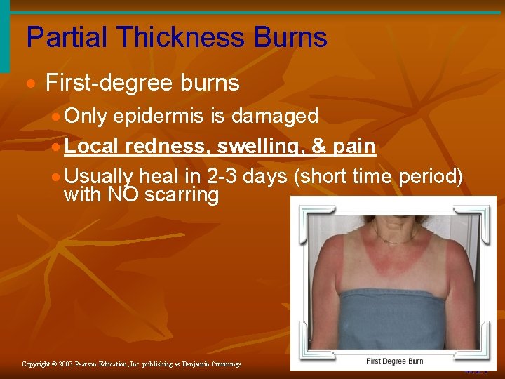 Partial Thickness Burns · First-degree burns · Only epidermis is damaged · Local redness,