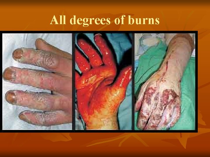 All degrees of burns 