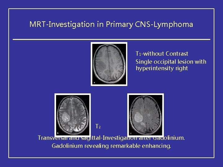 MRT-Investigation in Primary CNS-Lymphoma T 1 -without Contrast Single occipital lesion with hyperintensity right