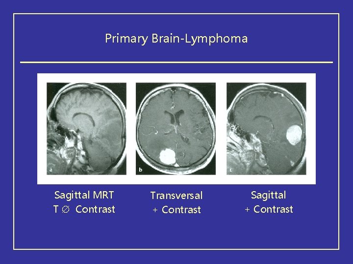 Primary Brain-Lymphoma Sagittal MRT T Contrast Transversal + Contrast Sagittal + Contrast 