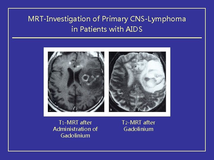 MRT-Investigation of Primary CNS-Lymphoma in Patients with AIDS T 1 -MRT after Administration of