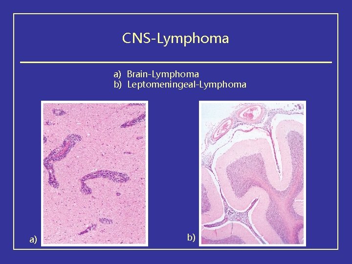 CNS-Lymphoma a) Brain-Lymphoma b) Leptomeningeal-Lymphoma a) b) 