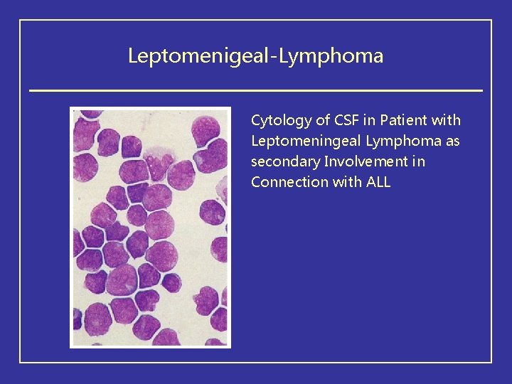 Leptomenigeal-Lymphoma Cytology of CSF in Patient with Leptomeningeal Lymphoma as secondary Involvement in Connection