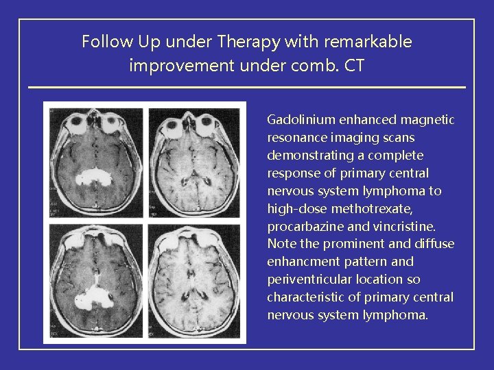 Follow Up under Therapy with remarkable improvement under comb. CT Gadolinium enhanced magnetic resonance