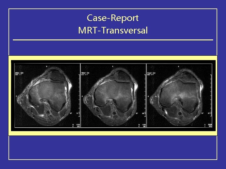 Case-Report MRT-Transversal 