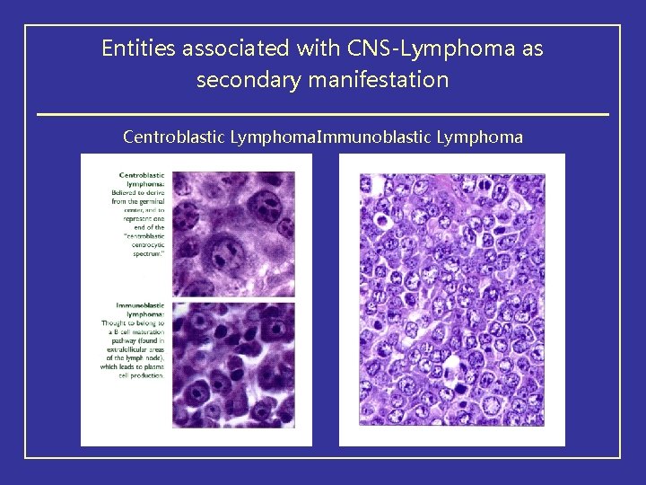 Entities associated with CNS-Lymphoma as secondary manifestation Centroblastic Lymphoma. Immunoblastic Lymphoma 