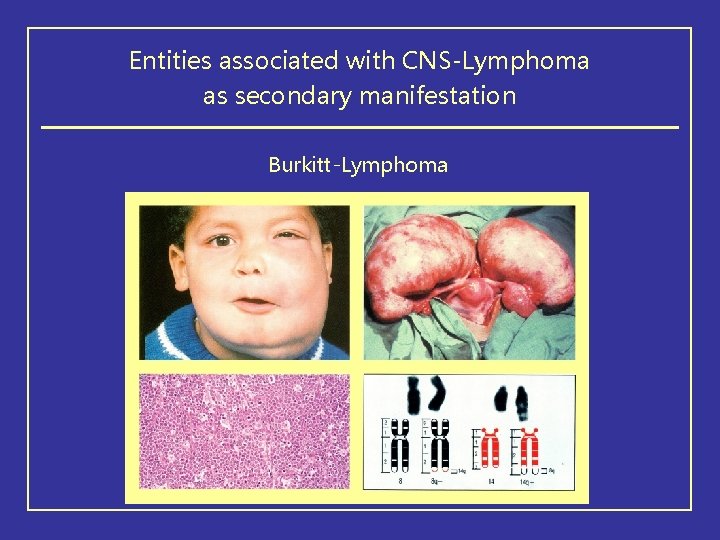 Entities associated with CNS-Lymphoma as secondary manifestation Burkitt-Lymphoma 