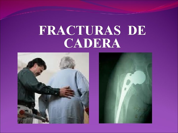 FRACTURAS DE CADERA FRACTURAS DE CADERA
