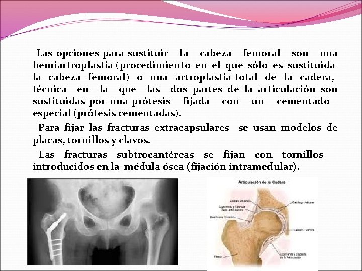 Las opciones para sustituir la cabeza femoral son una hemiartroplastia (procedimiento en el Las opciones para sustituir la cabeza femoral son una hemiartroplastia (procedimiento en el