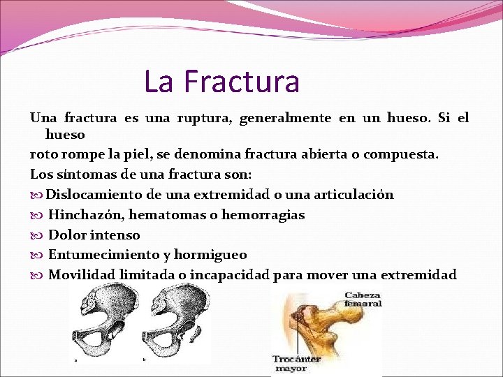 La Fractura Una fractura es una ruptura, generalmente en un hueso. Si el hueso La Fractura Una fractura es una ruptura, generalmente en un hueso. Si el hueso