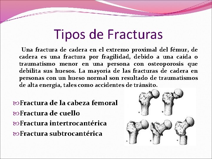 Tipos de Fracturas Una fractura de cadera en el extremo proximal del fémur, de Tipos de Fracturas Una fractura de cadera en el extremo proximal del fémur, de