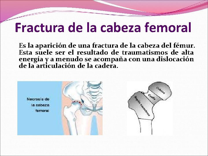 Fractura de la cabeza femoral Es la aparición de una fractura de la cabeza Fractura de la cabeza femoral Es la aparición de una fractura de la cabeza