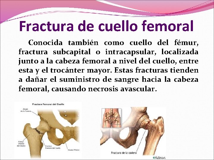Fractura de cuello femoral Conocida también como cuello del fémur, fractura subcapital o intracapsular, Fractura de cuello femoral Conocida también como cuello del fémur, fractura subcapital o intracapsular,