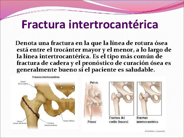 Fractura intertrocantérica Denota una fractura en la que la línea de rotura ósea está Fractura intertrocantérica Denota una fractura en la que la línea de rotura ósea está