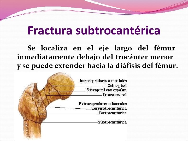 Fractura subtrocantérica Se localiza en el eje largo del fémur inmediatamente debajo del trocánter Fractura subtrocantérica Se localiza en el eje largo del fémur inmediatamente debajo del trocánter