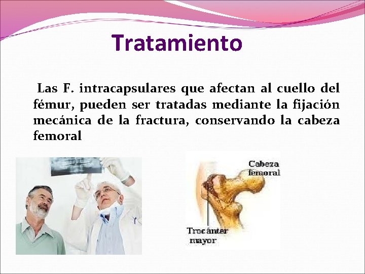 Tratamiento Las F. intracapsulares que afectan al cuello del fémur, pueden ser tratadas mediante Tratamiento Las F. intracapsulares que afectan al cuello del fémur, pueden ser tratadas mediante