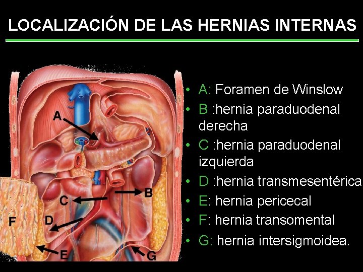 LOCALIZACIÓN DE LAS HERNIAS INTERNAS • A: Foramen de Winslow • B : hernia