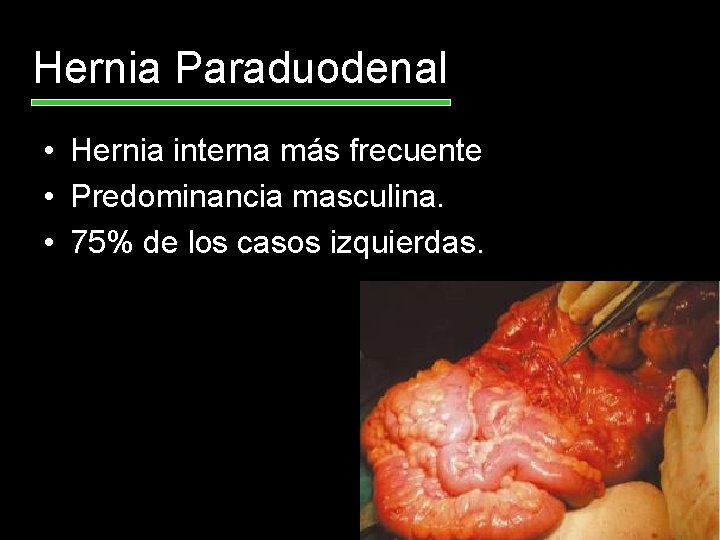 Hernia Paraduodenal • Hernia interna más frecuente • Predominancia masculina. • 75% de los