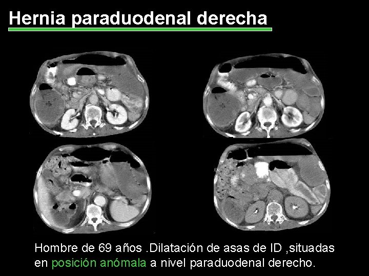 Hernia paraduodenal derecha Hombre de 69 años. Dilatación de asas de ID , situadas