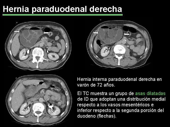 Hernia paraduodenal derecha Hernia interna paraduodenal derecha en varón de 72 años. El TC