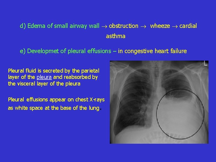 d) Edema of small airway wall obstruction wheeze cardial asthma e) Developmet of pleural