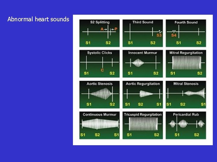 Abnormal heart sounds 