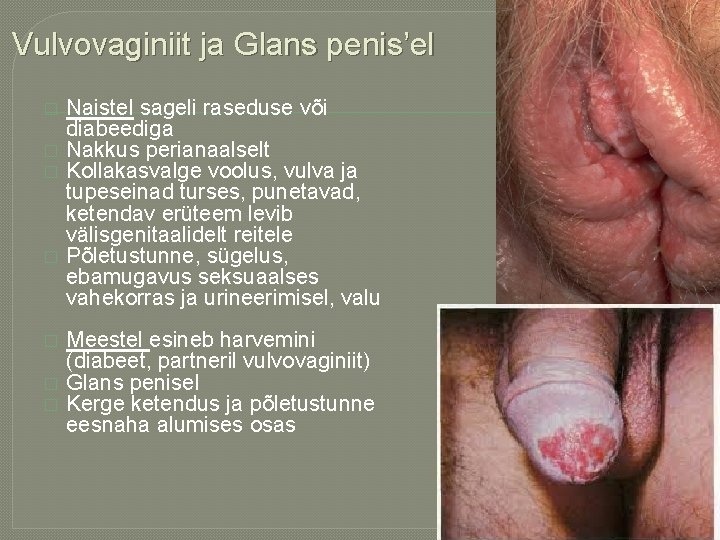 Vulvovaginiit ja Glans penis’el � � � � Naistel sageli raseduse või diabeediga Nakkus