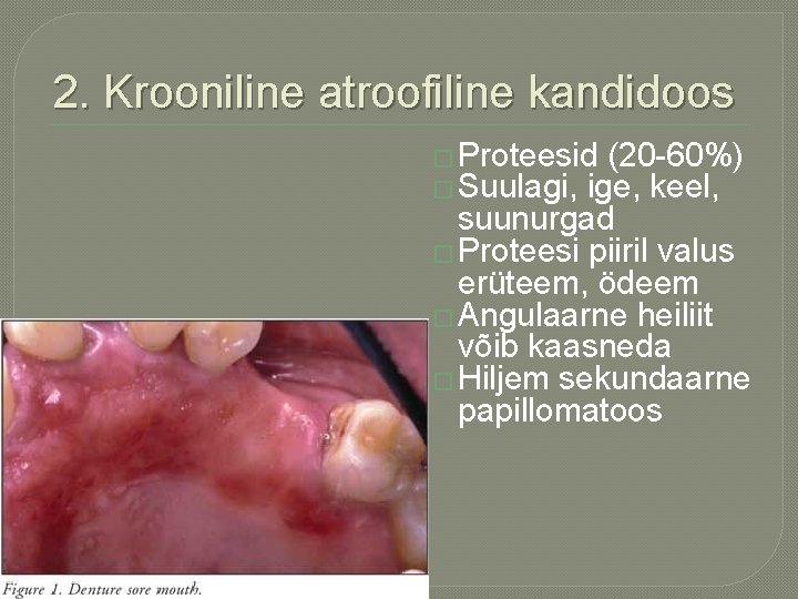 2. Krooniline atroofiline kandidoos � Proteesid (20 -60%) � Suulagi, ige, keel, suunurgad �