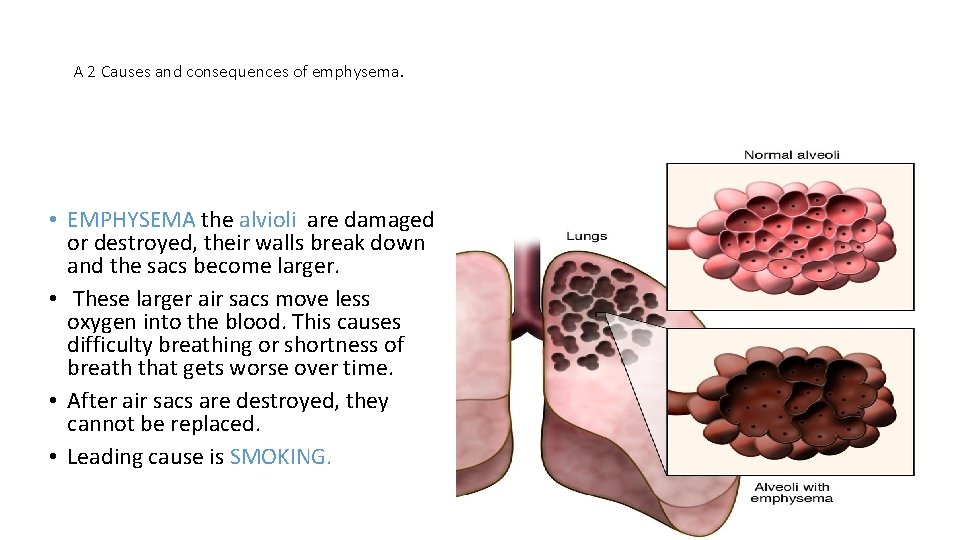 A 2 Causes and consequences of emphysema. • EMPHYSEMA the alvioli are damaged or