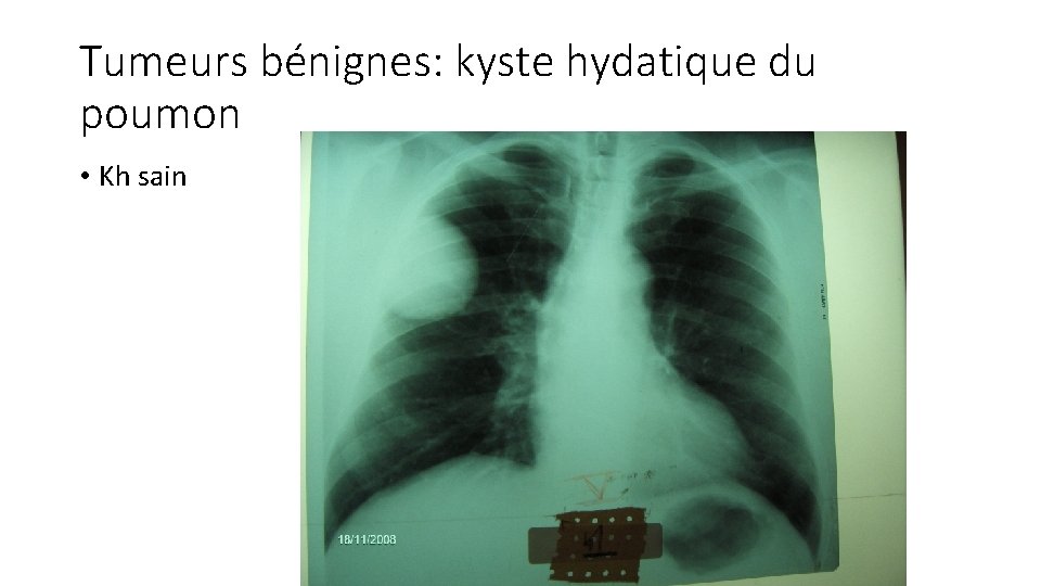 Tumeurs bénignes: kyste hydatique du poumon • Kh sain 