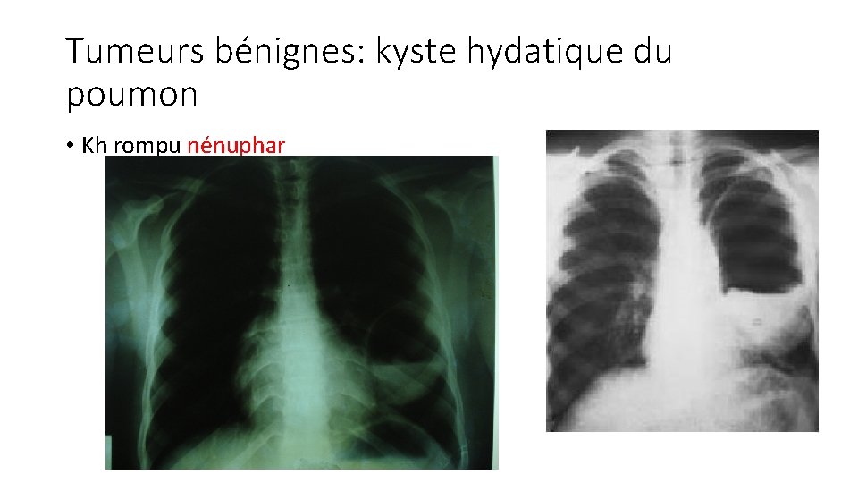 Tumeurs bénignes: kyste hydatique du poumon • Kh rompu nénuphar 